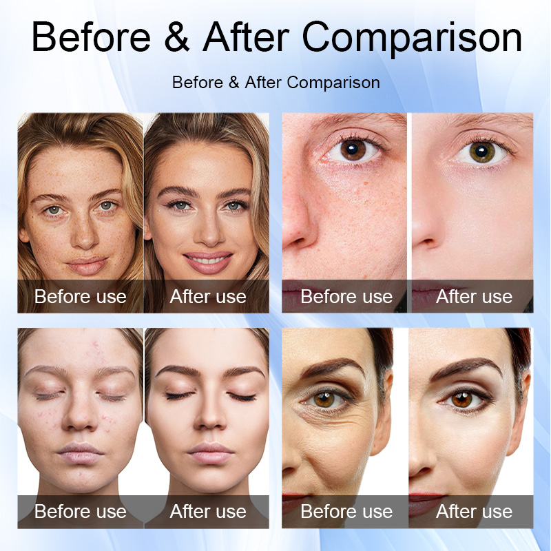 Professional Nano Mesotherapy Sprayer for Skin Rejuvenation
